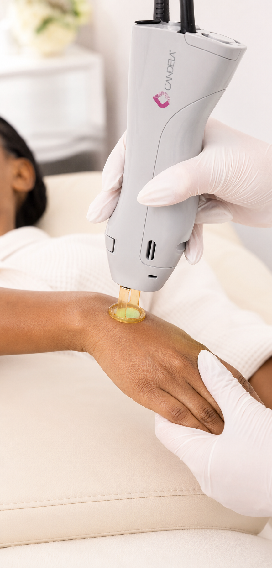 Laser Facial im Gesicht mit dem Handstück des Candela GentleMax Pro Plus
